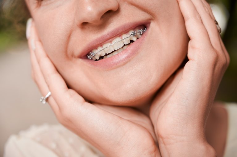 los brackets te cambian la cara