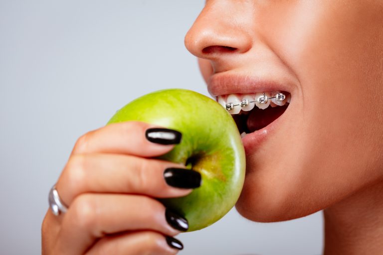 que no se puede comer con brackets
