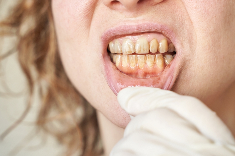 Dientes amarillos causas