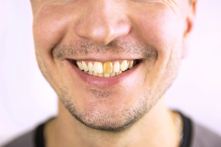 Dientes amarillos causas