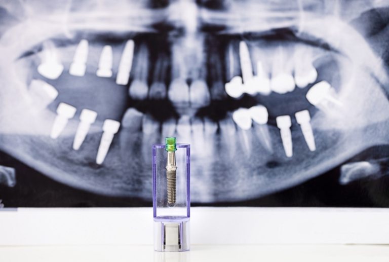 Implante dental infectado