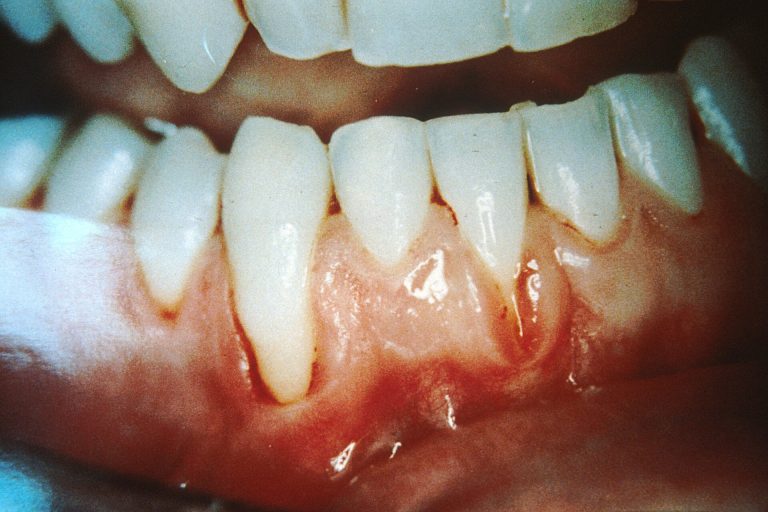 Encía retraída en los dientes inferiores con parte de la raíz a la vista